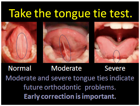 image-tongue-tie-test